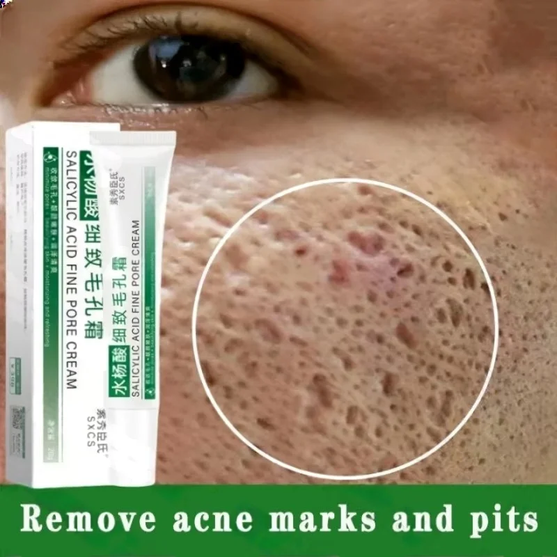 Salicylzuur Porie Clearing Cre - Salicylic Acid Blackhead Remover recensie en prijs