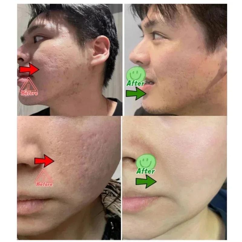 Salicylzuur Porie Clearing Cre - Salicylic Acid Blackhead Remover recensie en prijs